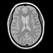 Proton density axial scan of the brain