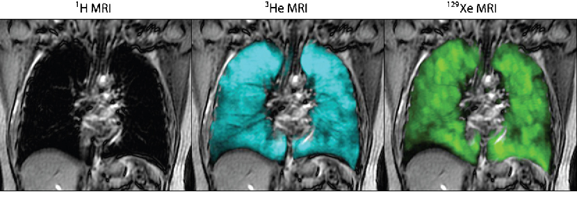 figure showing the quality of scans of lungs with Hydrogen, Helium, and Xeon MRI scans (latter being higher quality)